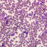 A5, Bone Marrow, 40x (Wright)
