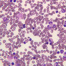 A5, Bone Marrow, 40x (Wright)