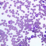 A5, Bone Marrow, 40x (Wright)