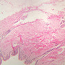 A58, Axillary Skin, 2.5x (H&E)